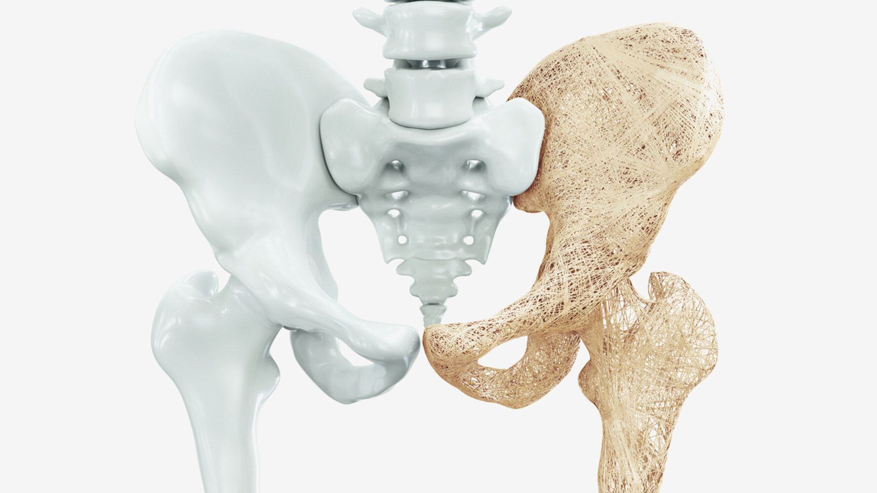 Día Mundial de la Osteoporosis: ¿Cuáles son los síntomas y cómo se puede prevenir?