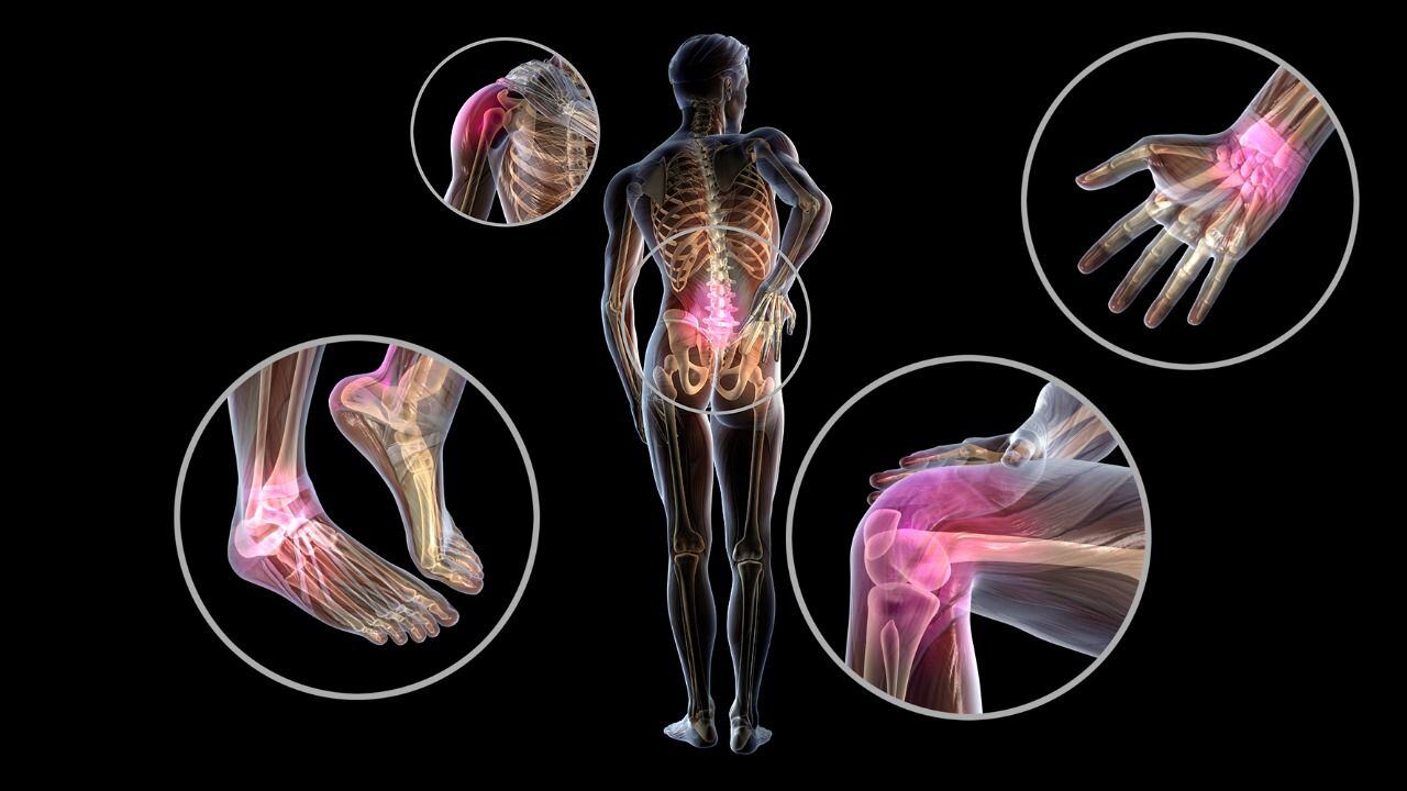 La artritis reumatoide provoca hinchazón, rigidez y fatiga. (Shutterstock)