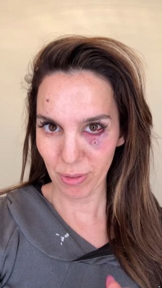 Por ahora los fragmentos de bala permanecerán dentro del ojo de la actriz, ya que no se pueden extraer. (Foto: @thechristycarlsonromano)