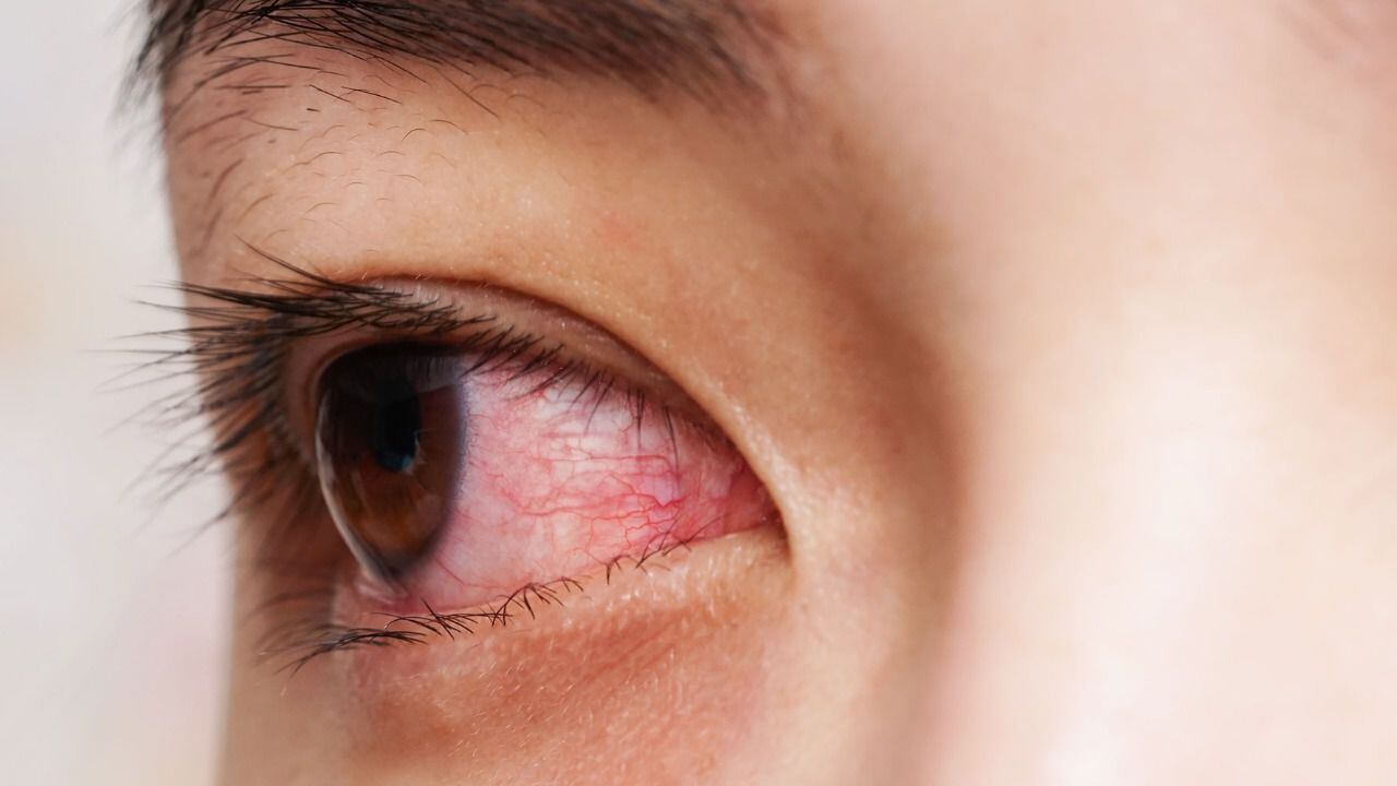 El tutupiche es una forma de infección en los ojos. 