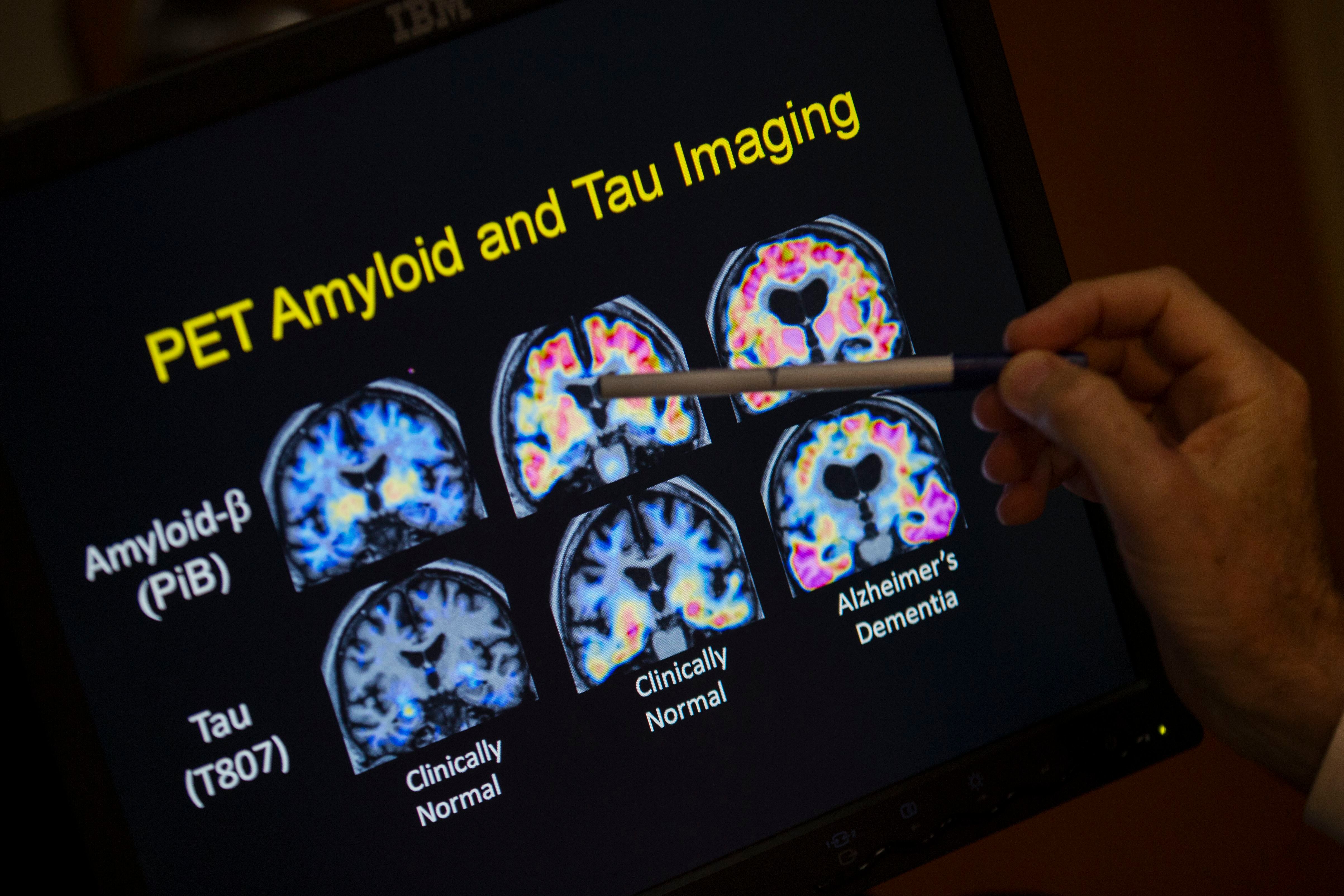 ¿La memoria tiene color rojo? Nuevos analisis de sangre detectarán más rápido casos de Alzheimer