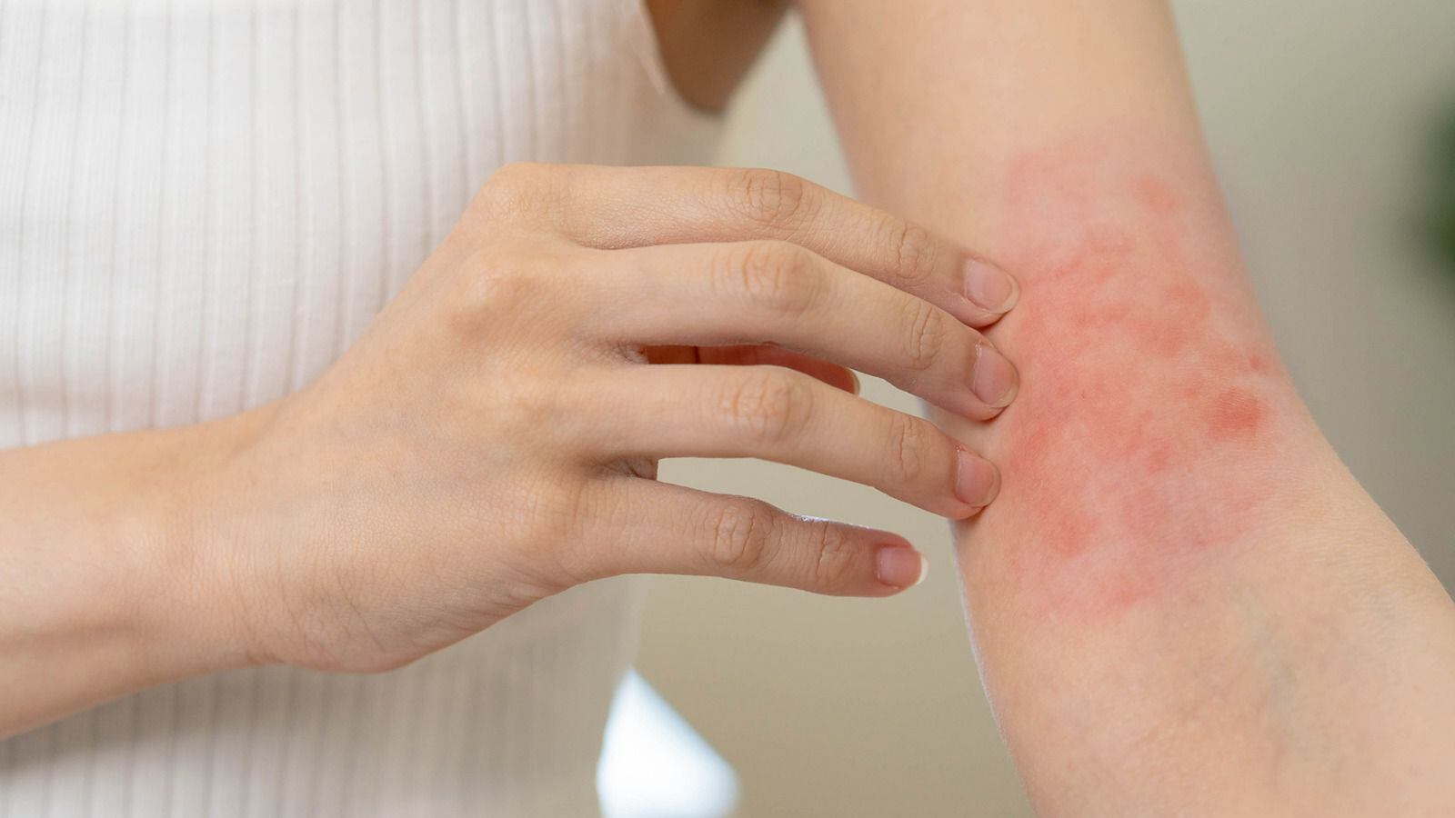 El síndrome de Stevens-Johnson causa sarpullido en la piel y otras partes del cuerpo. (Foto: Shutterstock)