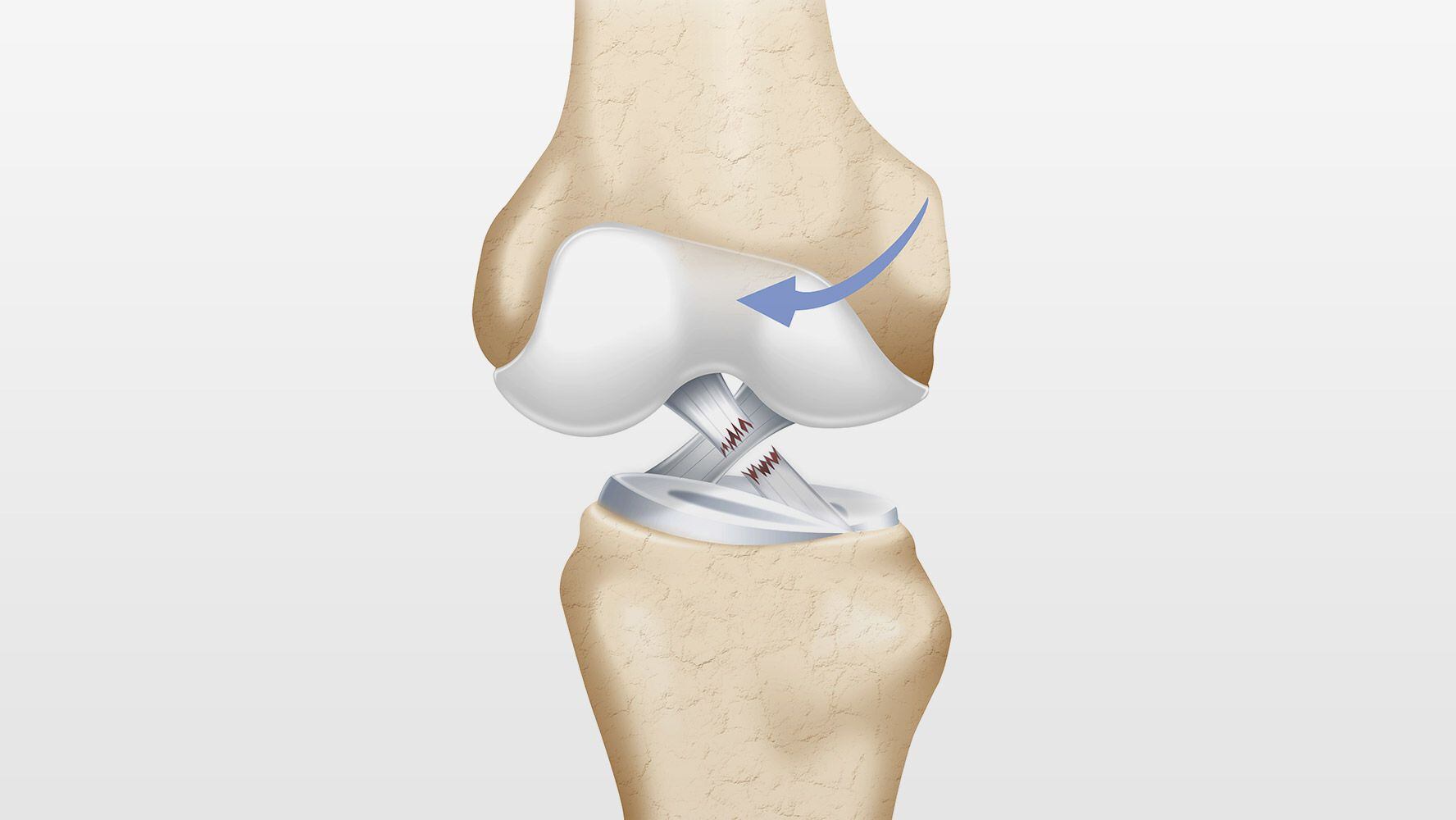 Ilustración de una rotura de ligamento cruzado en la rodilla. (Foto: Shutterstock)